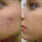 Acne-Treatment