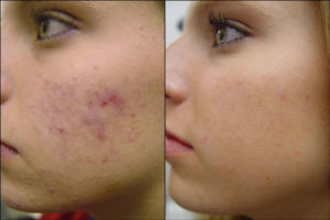 Acne-Treatment