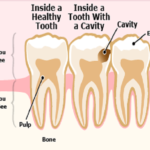 avoid-cavity-in-teeth