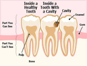 avoid-cavity-in-teeth