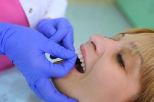 Everything You Need to Know About Dental Veneers